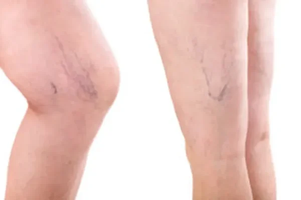 Did You Know that Unhealthy Veins Can Lead to Unhealthy Legs?