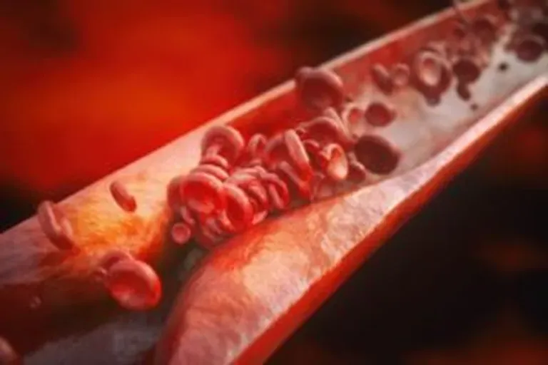 Are You At Risk For PAD?