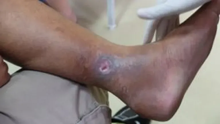 What are Venous Leg Ulcers and What Causes Them