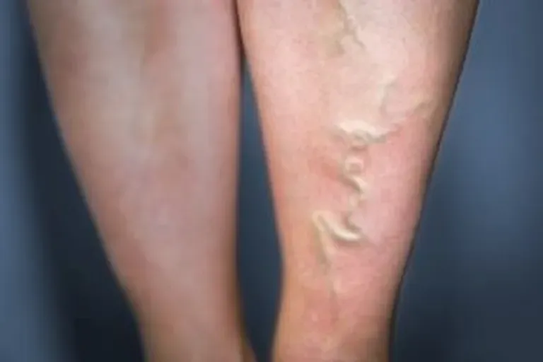 What is Thrombophlebitis Jun 06, 2018