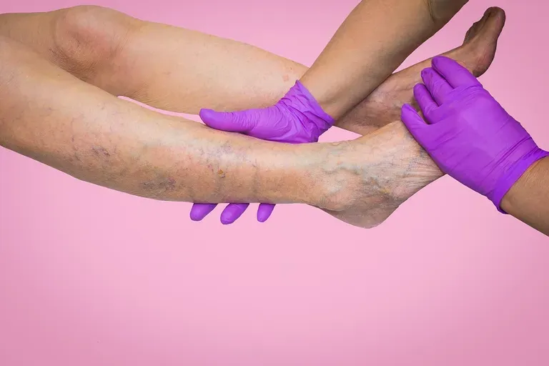 Banish Spider Veins with Sclerotherapy