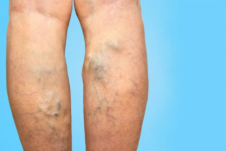 Tips to Manage Chronic Venous Insufficiency